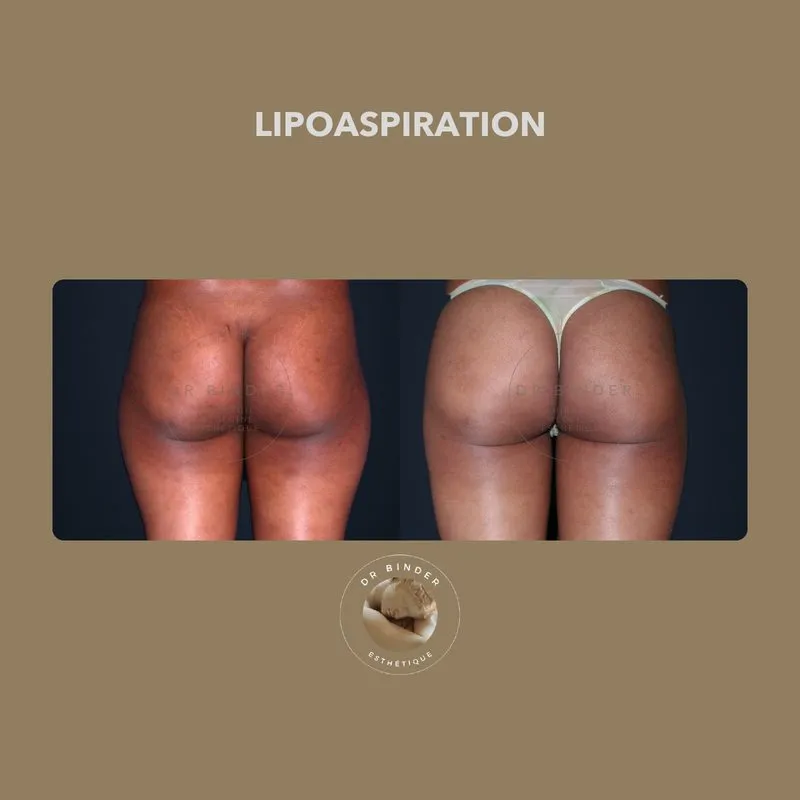 Avant et après une lipoaspiration des cuisses, de dos, photo publiée avec l’accord de la patiente