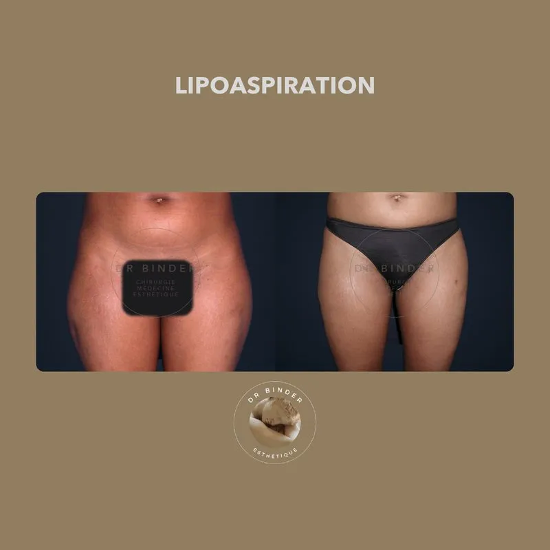 Avant et après une lipoaspiration des cuisses, de face, photo publiée avec l’accord de la patiente