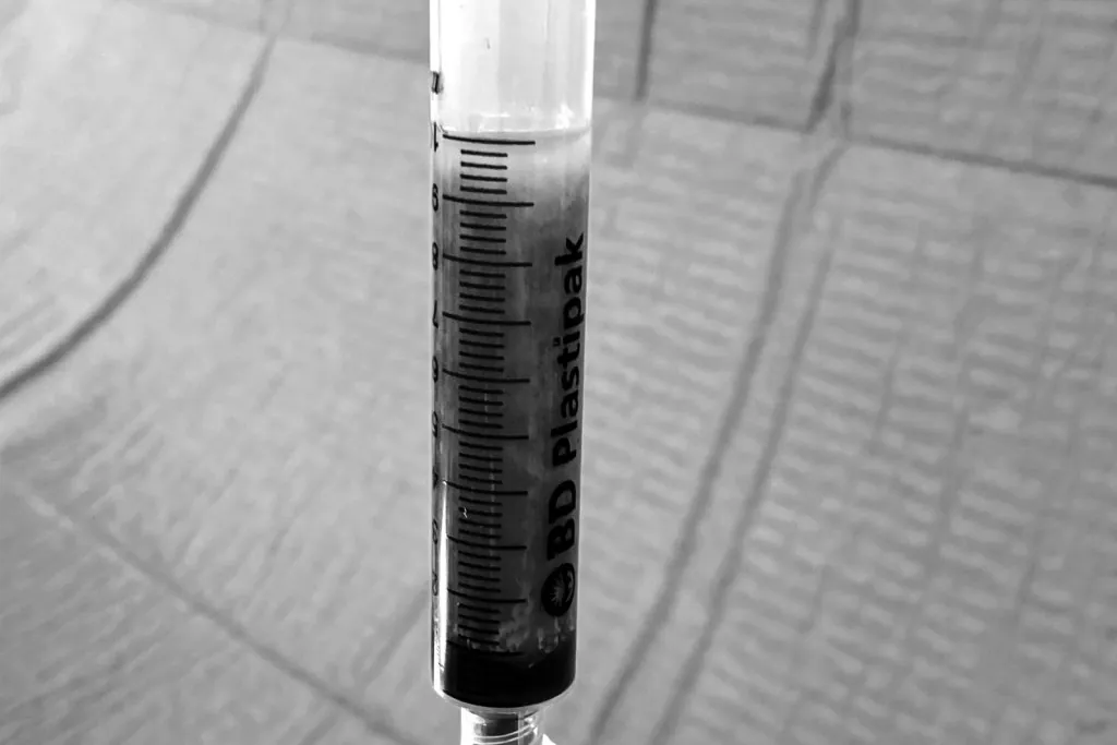 Seringue de graisse purifiée prête à être réinjectée lors d un lipofilling