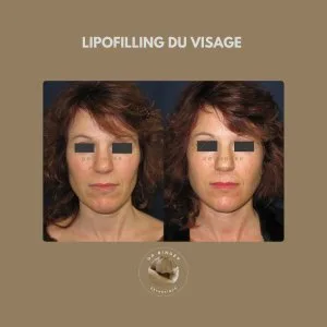 Lipofilling du visage, de face Avant et après un lipofilling du visage, de face, photo publiée avec l'accord de la patiente