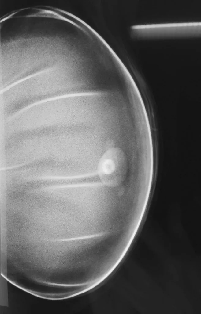 Mammographie d’un sein porteur d’un implant mammaire