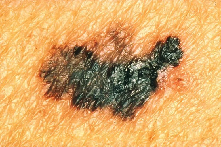 Mélanome de plusieurs couleurs, brun, noir et bleuté