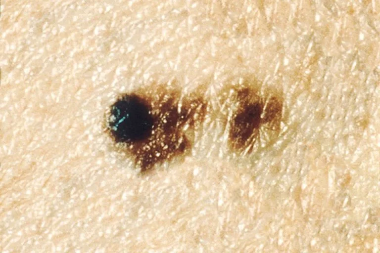 Grain de beauté atypique évoluant en mélanome
