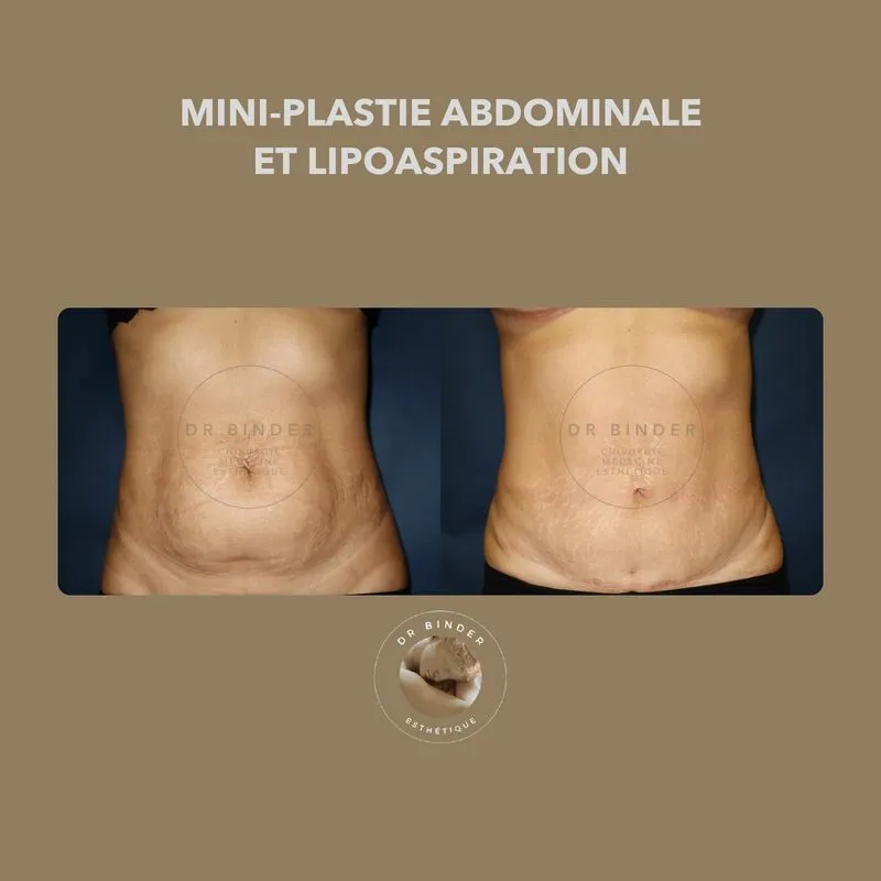 Avant et après une mini-plastie abdominale associée à une lipoaspiration, de face, photo publiée avec l’accord de la patiente