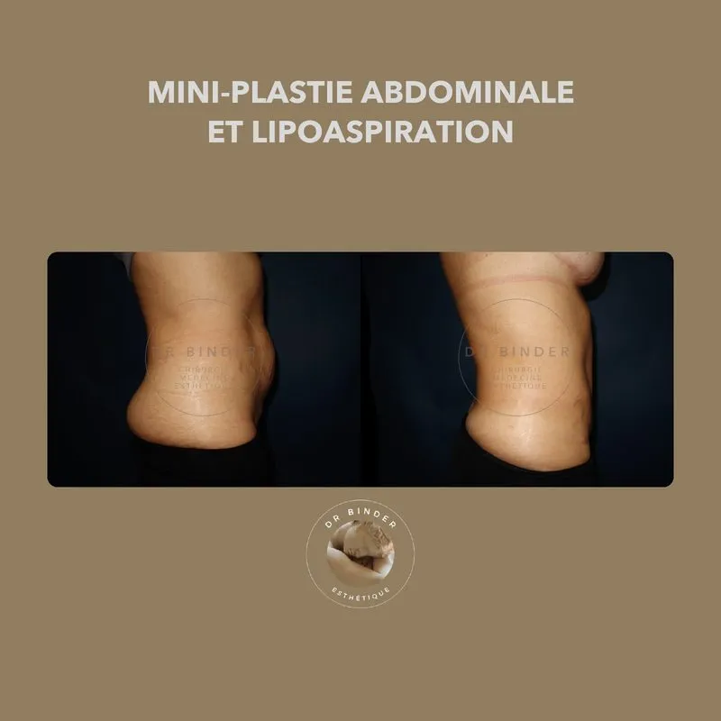 Avant et après une mini-plastie abdominale associée à une lipoaspiration, de profil, photo publiée avec l’accord de la patiente