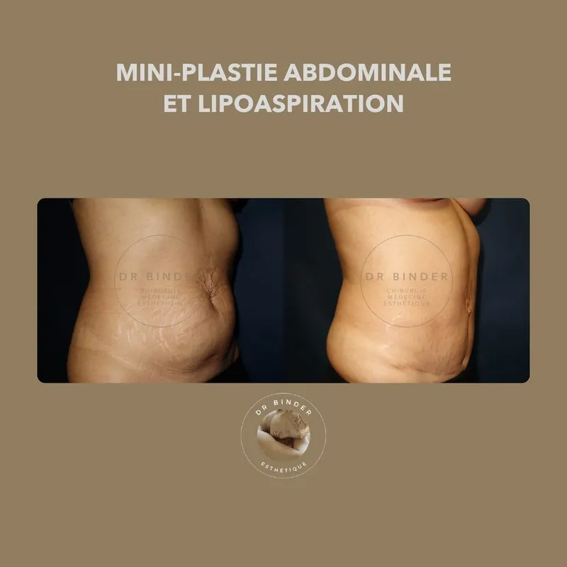 Avant et après une mini-plastie abdominale associée à une lipoaspiration, de trois-quarts, photo publiée avec l’accord de la patiente