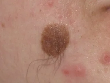 Naevus pileux, grain de beauté brun avec des poils