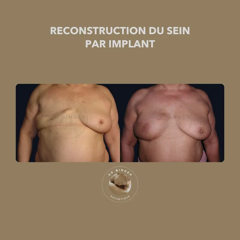 Avant et après une reconstruction du sein par implant, de face, photo publiée avec l’accord de la patiente