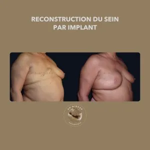 Avant et après une reconstruction du sein par implant, de trois-quarts, photo publiée avec l’accord de la patiente