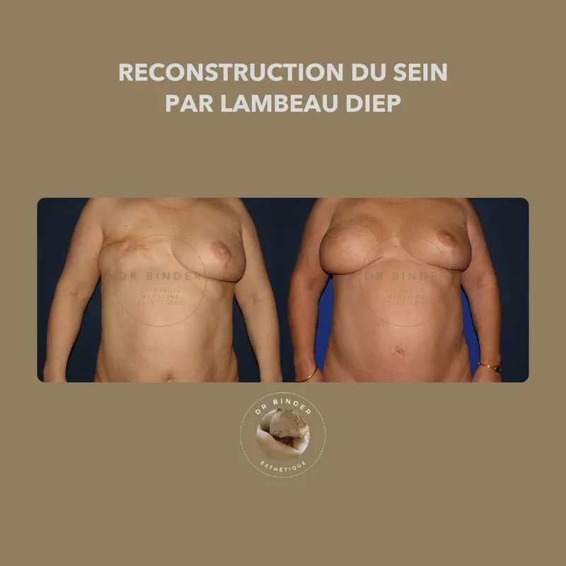 Avant et après une reconstruction du sein par lambeau DIEP, photo publiée avec l’accord de la patiente