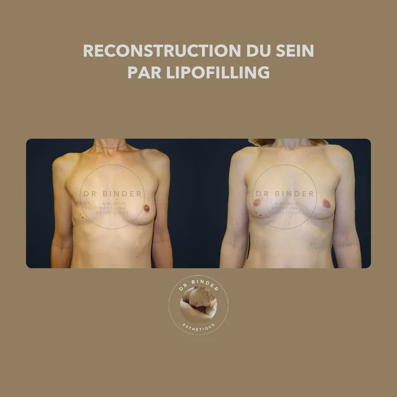 Avant et après une reconstruction du sein par lipofilling, photo publiée avec l’accord de la patiente