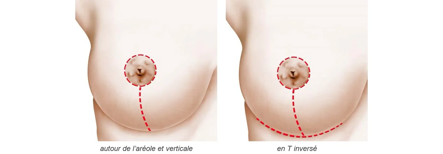Réduction mammaire : cicatrices Schéma de deux seins vus de face montrant les cicatrices de la réduction mammaire : autour de l’aréole et verticale, en T inversé