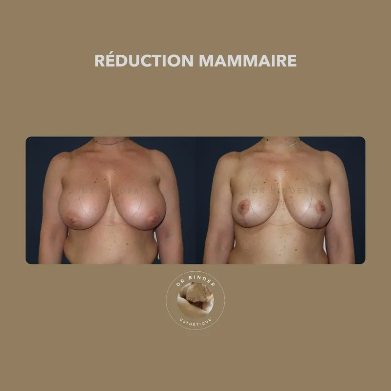 Avant et après une réduction mammaire, photo publiée avec l’accord de la patiente