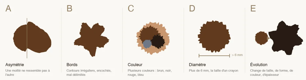 Règle ABCDE du mélanome : asymétrie, bords irréguliers, couleurs multiples, diamètre supérieur à 6 mm, évolution (schéma)