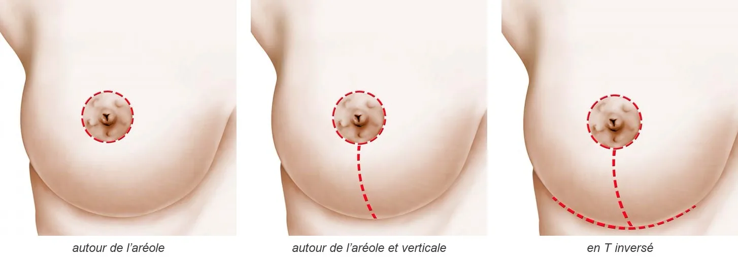 Cicatrices de la chirurgie du sein : autour de l’aréole, verticale, en T inversé Schéma de trois seins vus de face montrant les cicatrices possibles : autour de l’aréole, autour de l’aréole et verticale, en T inversé