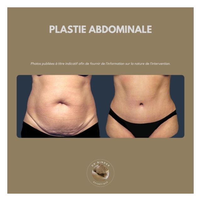 Abdominoplastie ou plastie abdominale | Dr Binder Jean-Philippe